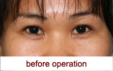 plastic-surgery-blepharoplasty